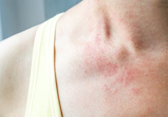 Shingles Rash On Neck And Shoulder ?auto=format